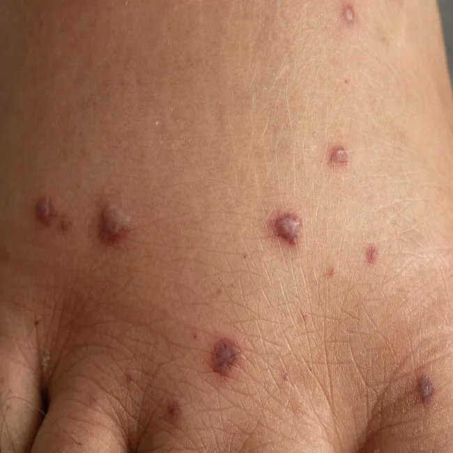 Grudki na skórze choroba Behçeta 