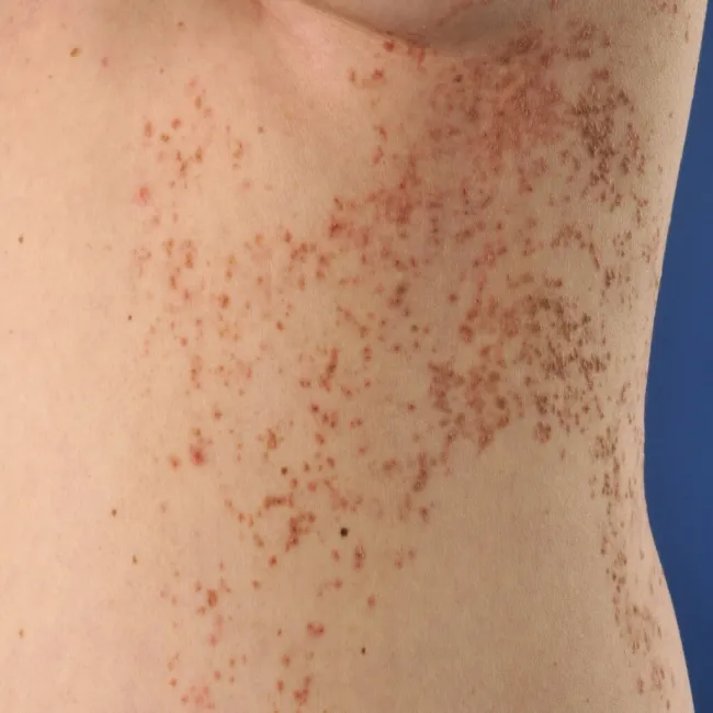 Grudki na skórze choroba Dariera