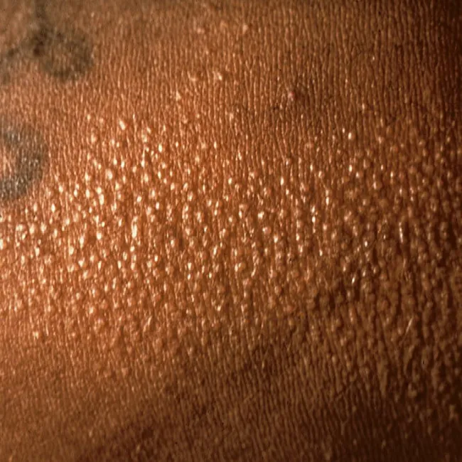 Grudki na skórze liszaj lsniący