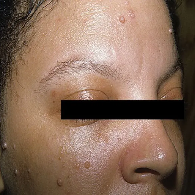 Grudki o barwie cieliste na twarzy