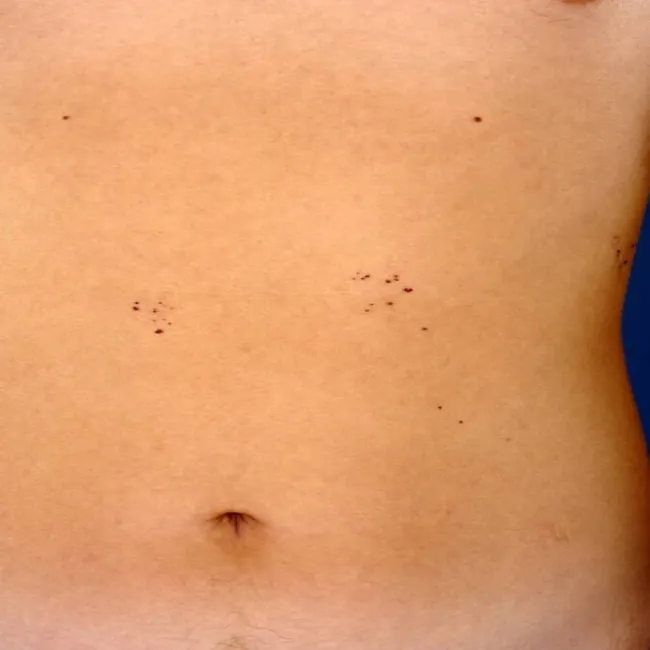 Grudki o czerwonawo-fioletowym zabarwieniu choroba Fabry'ego