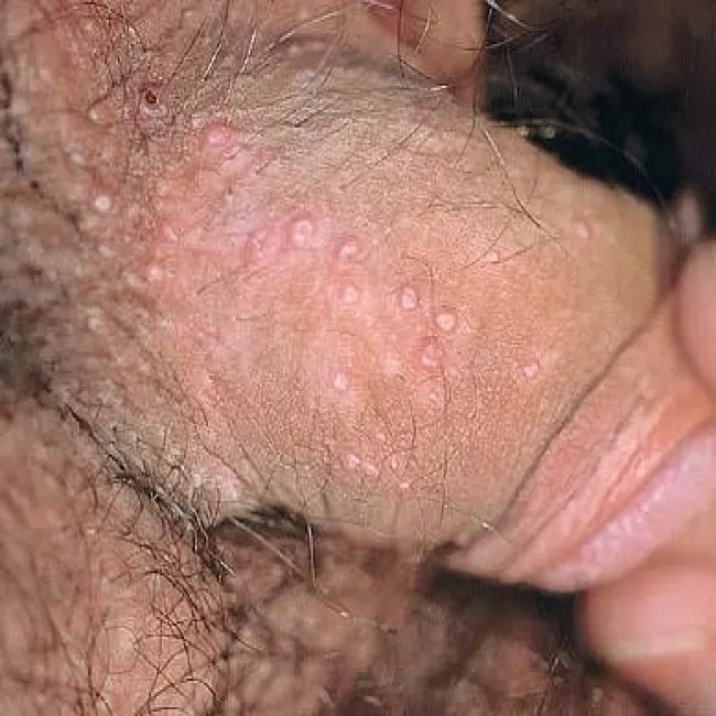 Grudki okolic intymnych na zewnątrz