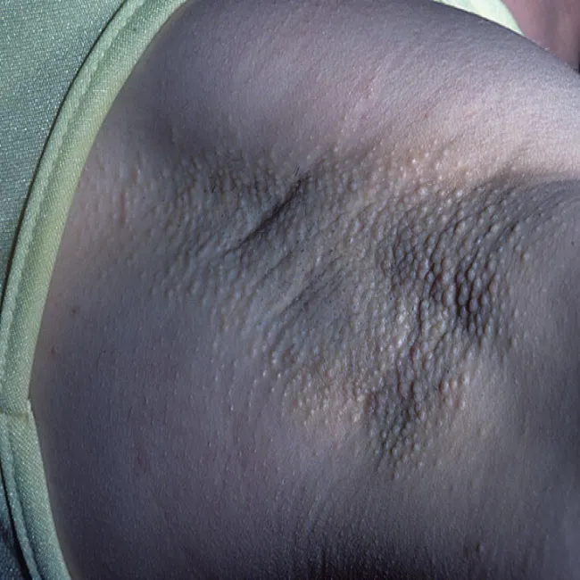 Grudki pod pachą choroba Foxa-Fordyce'a