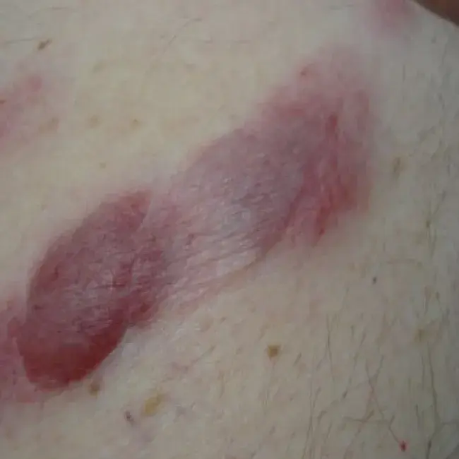 Grudki różowawo-fioletowe na skórze choroba Kimury