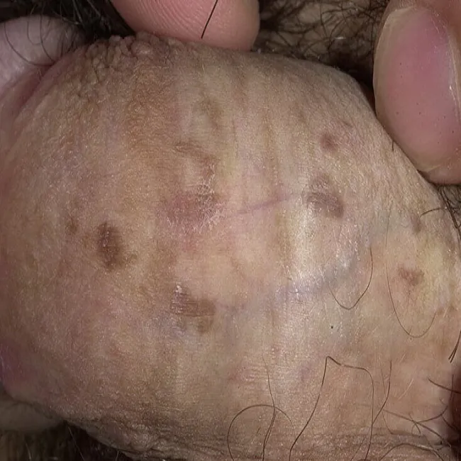 Grudkowatość bowenoidalna zdjęcie