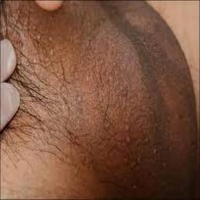 Grudkowatość bowenoidalna moszny