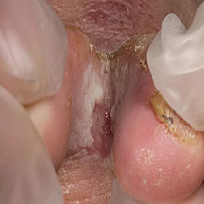 Grzybica między palcami nóg stopa atlety