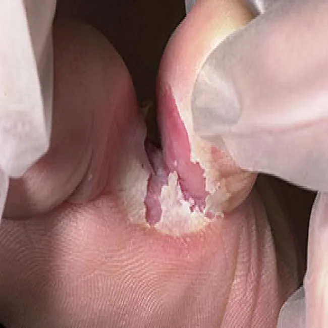 Grzybica między palcami nóg stopa sportowca