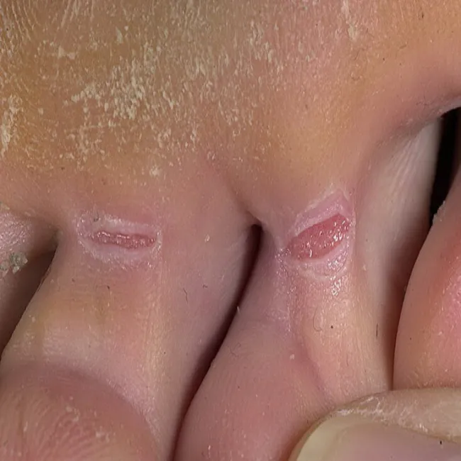 Grzybica między palcami