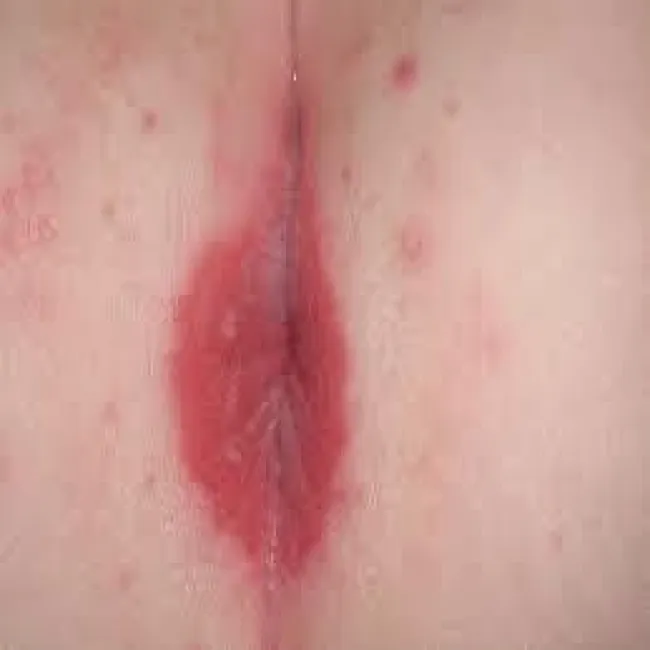 Grzybica odbytu u dziecka zapalenie pieluszkowe skóry