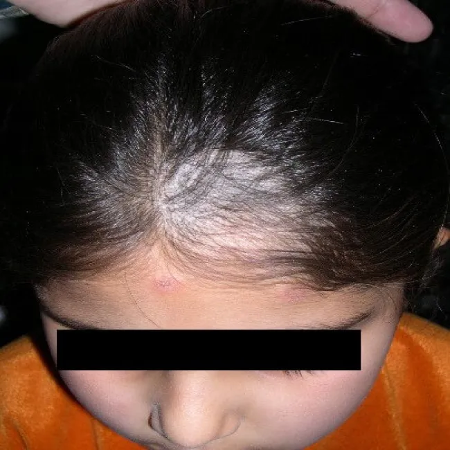 Grzybica owłosionej skóry głowy u dziewczynki