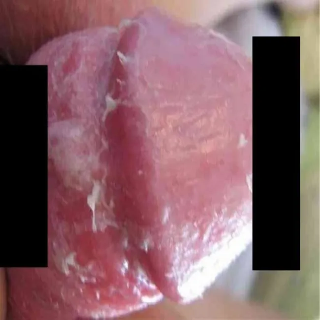 Grzybica penisa i napletka