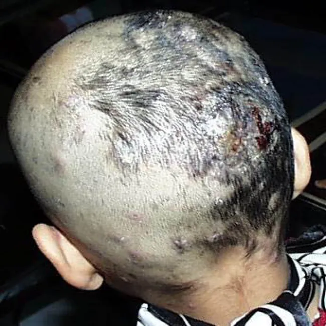 Grzybica skóry głowy galeria zdjęć