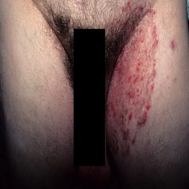 Grzybica uda u mężczyzny