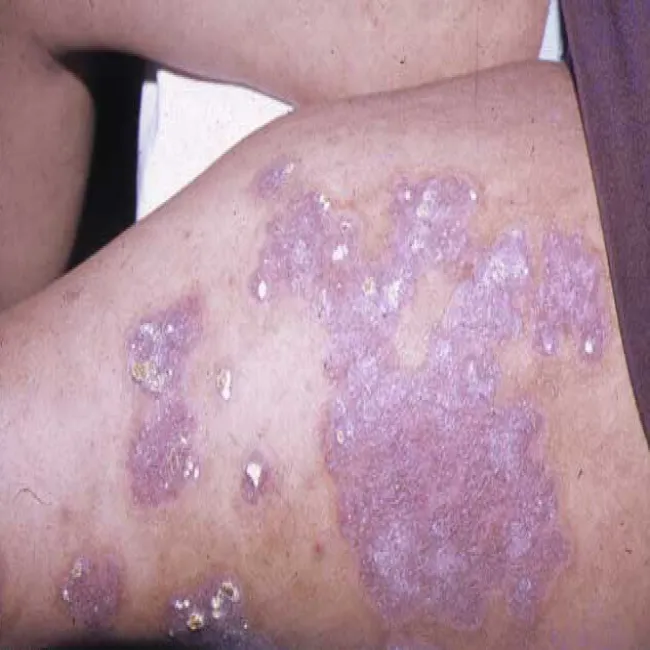 Grzybica woszczynowa tarczki woszczynowe żółte strupy 