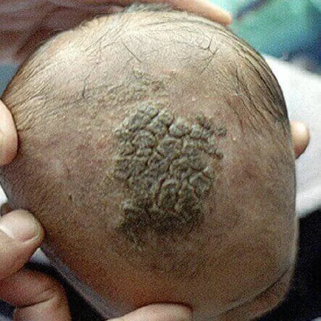 Grzybica woszczynowa z dużymi grubymi strupami