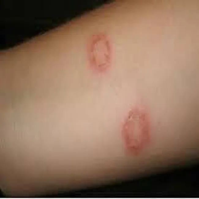 Grzybica skóry u dziecka na ręce