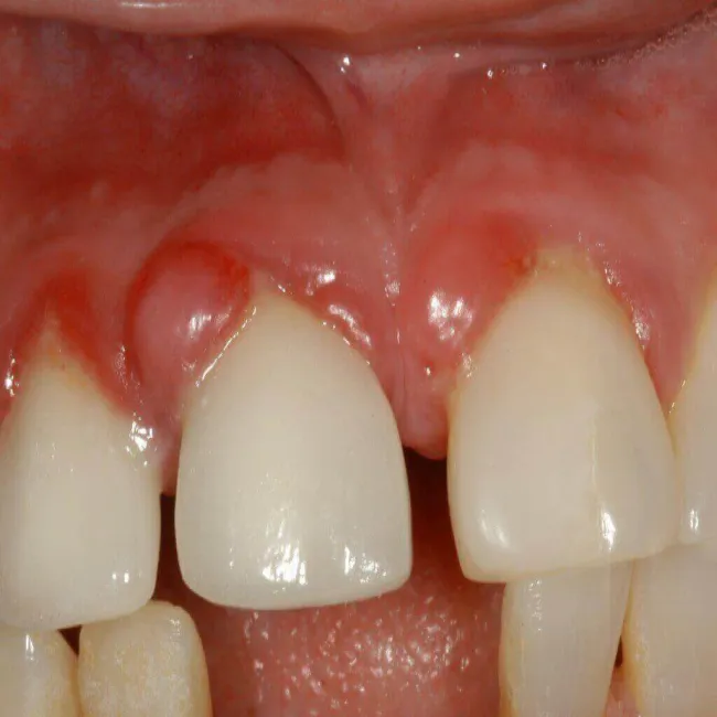 Guz ciążowy, ziarniniak ciężarnych