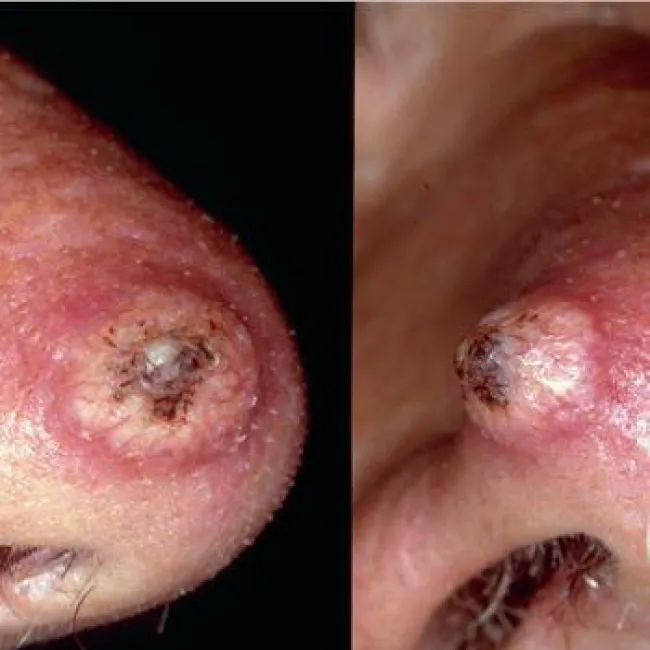 Guz na nosie rogowiak kolczystokomórkowy 