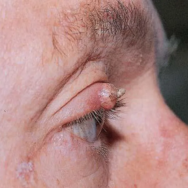 Guz na powiece rogowiak kolczystokomórkowy 