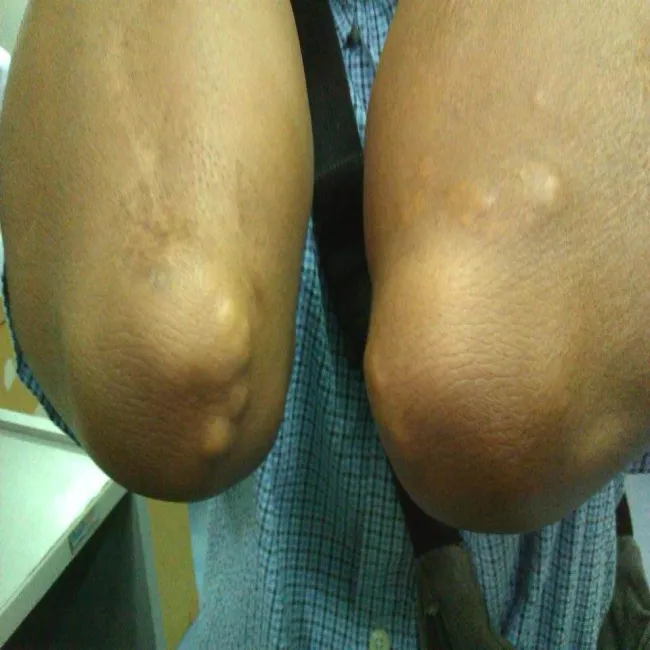 Guz skórny okolicy łokcia kępki żółte guzkowe