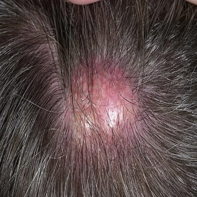 Guzek kaszak na głowie