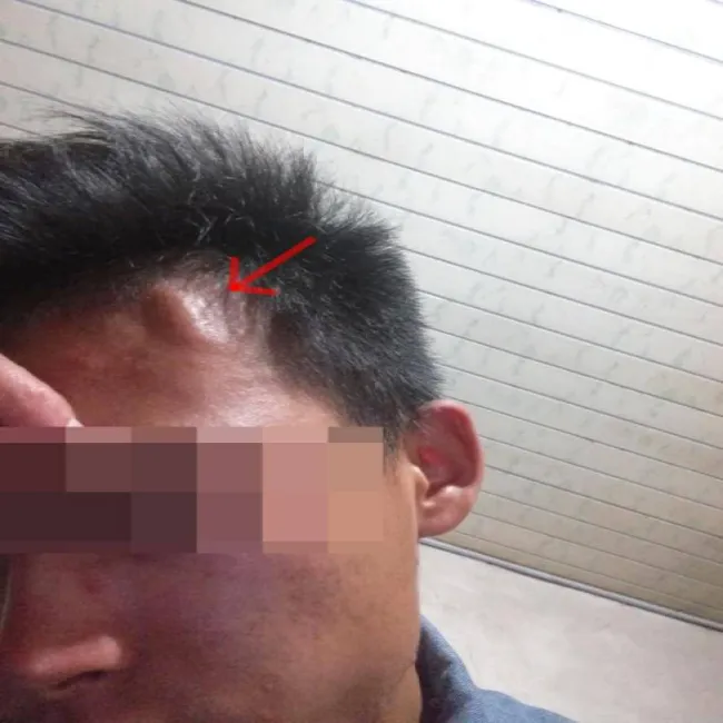 Guzek na czole choroba Kimury