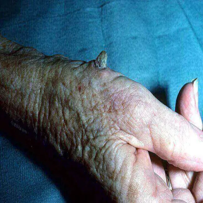 Guzek na dłoni róg skórny 