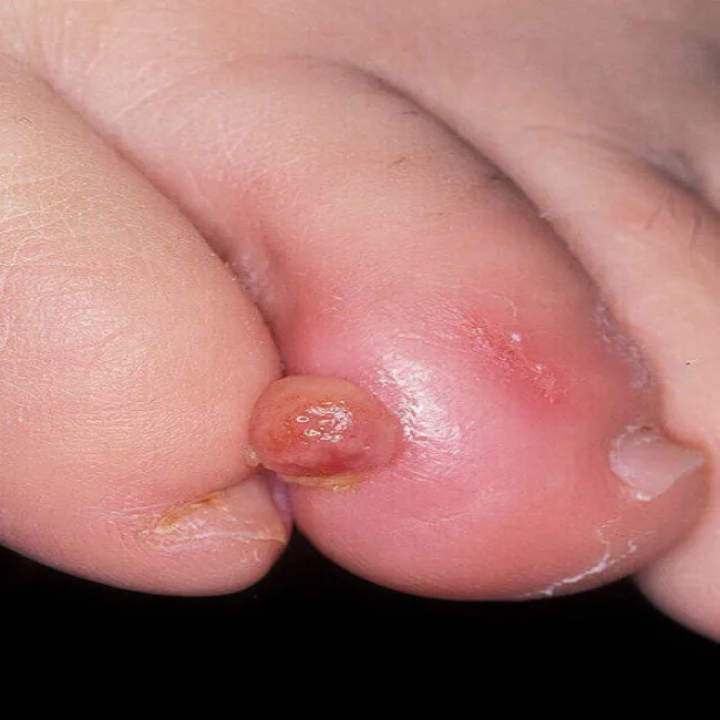 Guzek na palcu u nogi ziarniniak