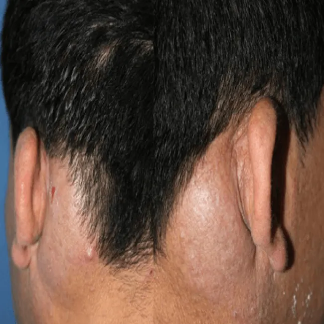 Guzek podskórnych w węzłach chłonnych głowy choroba Kimury