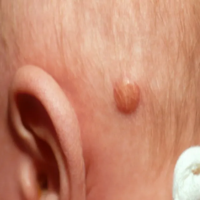 Guzek za uchem u dziecka żółtakoziarniniakowatość młodzieńcza 
