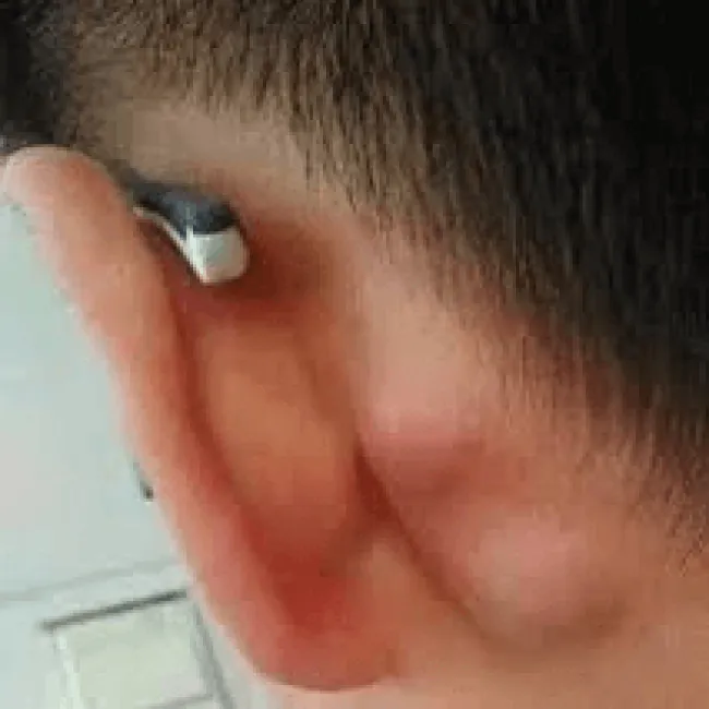 Guzek za uchem choroba Kimury