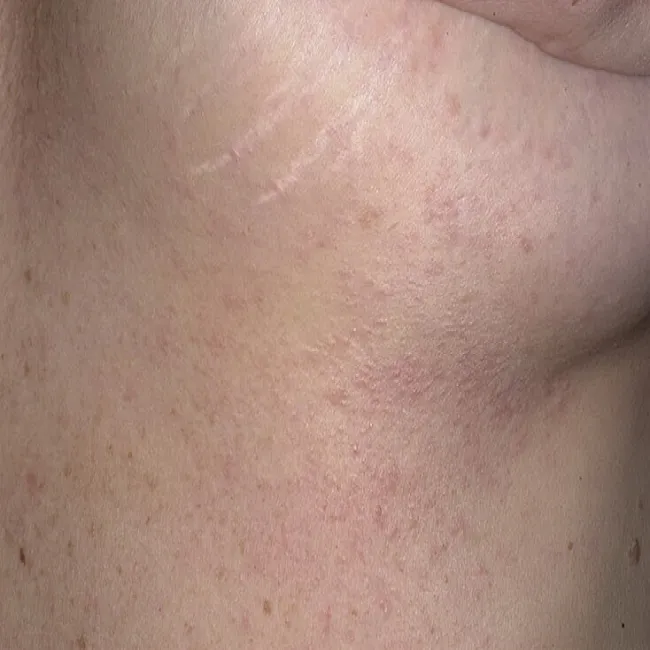 Guzki na skórze pod piersiami syringoma