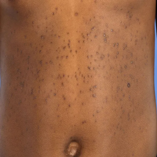 Guzki na skórze syringoma