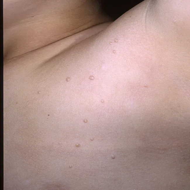 Guzki pod pachą u dziecka 