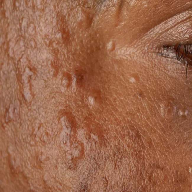 Guzki skórne syringoma