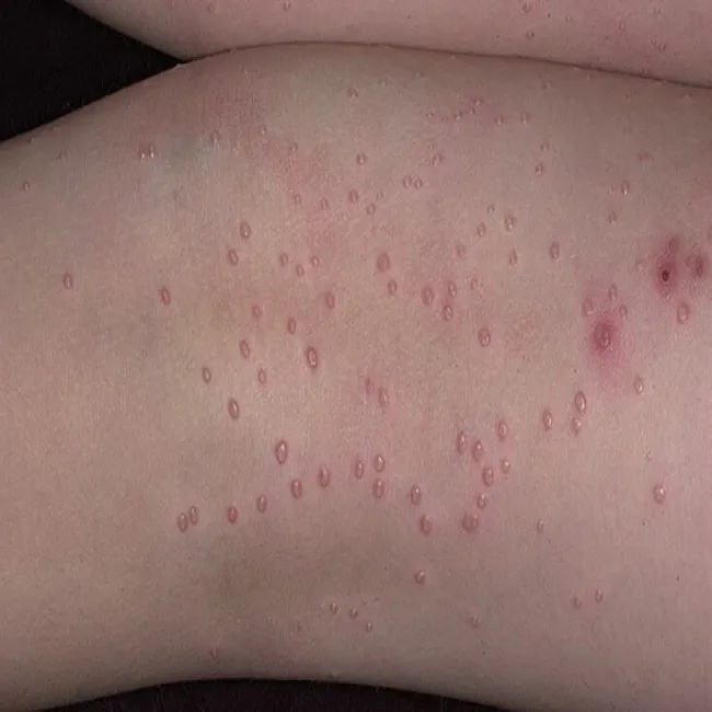 Guzki w mięczaku zakaźnym na skórze