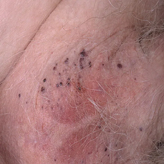 Guzki w okolicach intymnych kobiet rogowiec krwawy