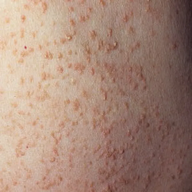 Guzki wielkości prosa na skórze choroba Kyrle