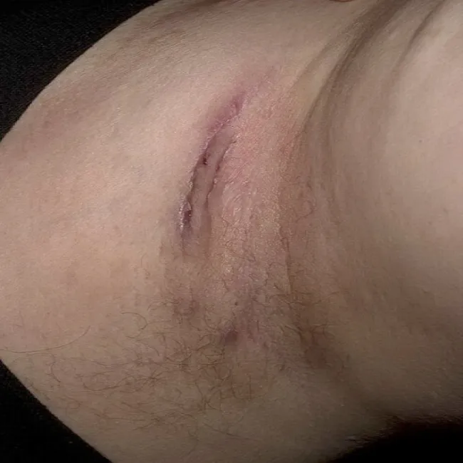 Hidradenitis suppurativa HS