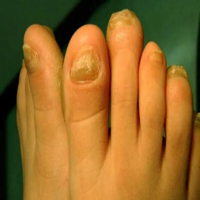 Hiperkeratoza paznokci