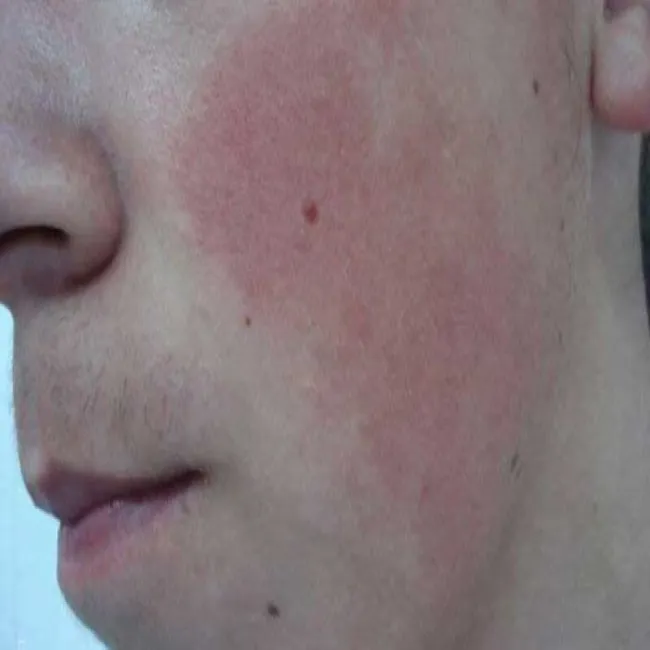 Hiperkeratoza skóry twarzy