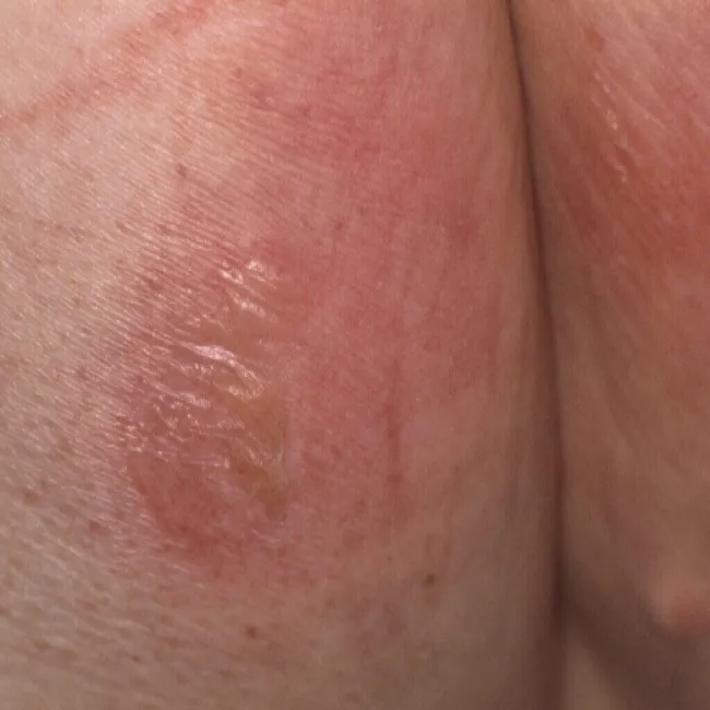 II stopień odleżyn zdjęcie