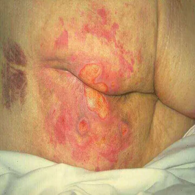 III stopień odleżyn zdjęcie