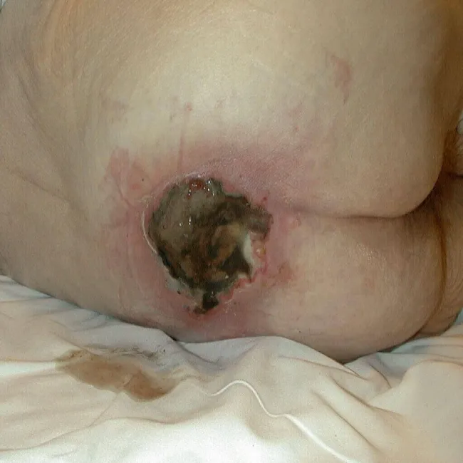 IV stopień odleżyn zdjęcie