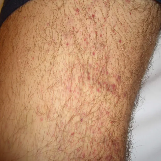 Idiopathic thrombocytopenic purpura
