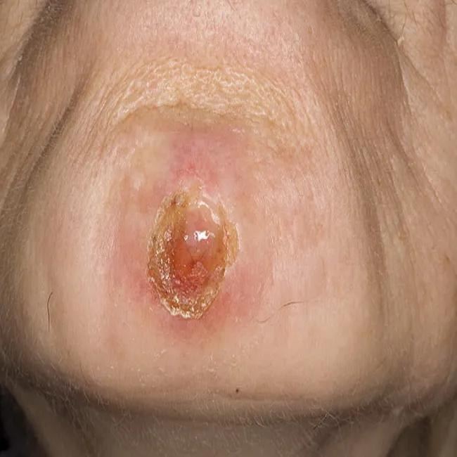 Infekcja bakteryjna liszajec zakaźny