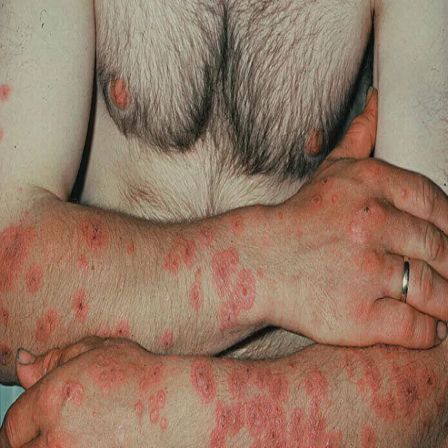 Inny rumień wielopostaciowy