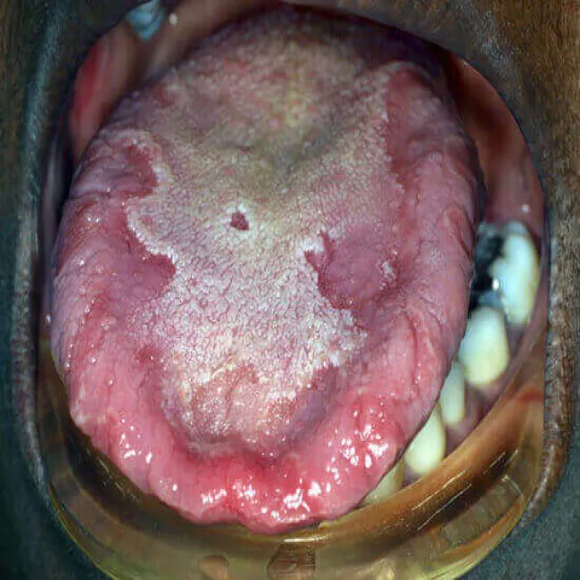 Język geograficzny u dorosłego