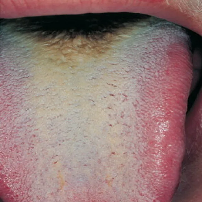 Język z ciemnobrązowym zabarwieniem 